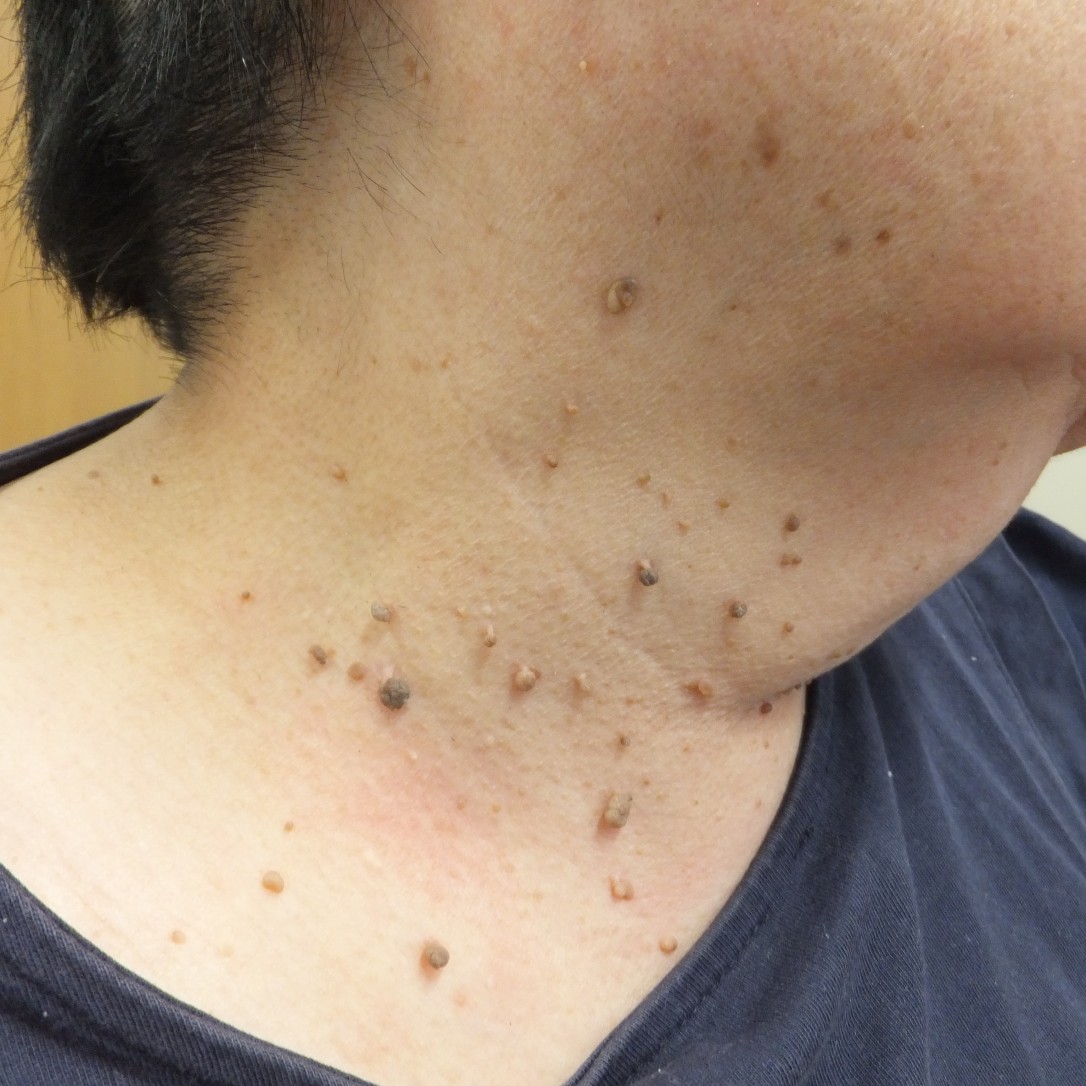 頚部疣贅(首のイボ)